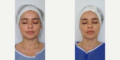 35-44 year old woman treated with Botox for TMJ - Masseter Botox
