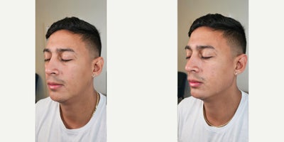 25-34 year old man treated with Dermal Fillers - Jawline and chin filler