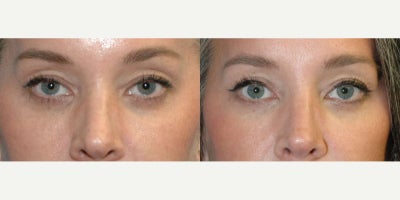 25-34 year old woman treated with Eyelid Surgery - This 33 year old female disliked the hooded and crowded appearance of her upper eyelids. She was treated with an upper eyelid lift (blepharoplasty). This procedure can be done while patients are asleep, or awake under local anesthesia. It is often combined with other surgical procedures. She loves the new shape of her eyes, just a few months after surgery with Dr. Scott Sattler of Sound Plastic Surgery in Seattle WA.