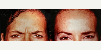 Patient treated with Botox - Patient treated with Botox