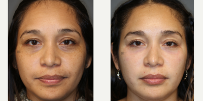 Syringoma Laser Treatment and Lower Lid Filler - Lower eyelid bumps (syringomas) and full facial laser with lower lid filler.