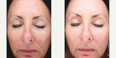 Woman treated with Fractional Laser - Procedures Performed: HALO