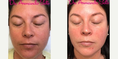 Woman treated with Laser Peel - Case Details:BBL Hero with Nano Laser Peel Combination Treatment (Before and two months after). Even younger patients benefit from the restoration of youthful glow achieved with such customized laser & light treatments as the one performed on this patient.