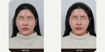 18-24 year old woman treated with Skin Rejuvenation - This patient underwent UltraCol treatment to improve facial contours, stimulate collagen production, and enhance overall skin quality. The treatment was designed to address mild volume deficiency while promoting gradual tissue regeneration and skin rejuvenation.