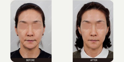 Revive Skin Booster for Improved Skin Elasticity and Overall Facial Rejuvenation - This patient underwent Revive treatment to improve skin quality, hydration, and elasticity while addressing visible signs of facial aging. The treatment was designed to support collagen production and enhance overall skin health, resulting in a smoother, firmer, and more refreshed appearance.