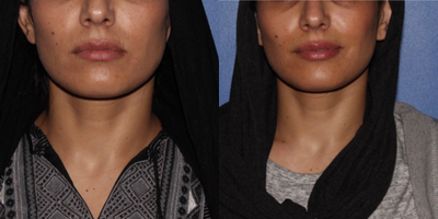 35-44 year old woman treated with Restylane Defyne - Patient came in wanting an all over lip enhancement and was injected with less than half a syringe of Defyne