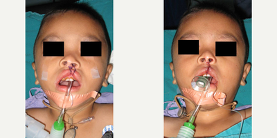 Cleft Lip And Palate Repair - This four year old boy had a lip adhesion procedure as an infant, with a poor cosmetic and functional result (left). A revision cleft lip repair with three layer closure and primary rhinoplasty was performed by Dr. Ransom (right).