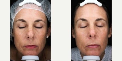 45-54 year old woman treated with Moxi - 1 MOXI Treatment