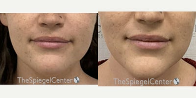 25-34 year old transgender woman treated with Jaw Surgery - 25-34 year old transgender woman treated with Jaw Surgery