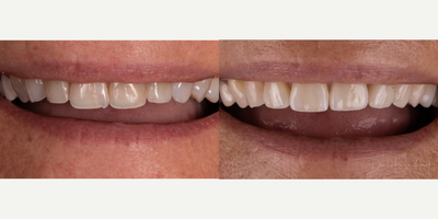 45-54 year old woman treated with Lumineers - Very minimal preparation utilized to enhance upper smile. Alignment, shape, shade and volume all adjusted with the addition of four upper porcelain hand-layered veneers.