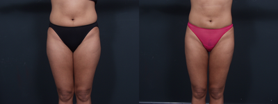 Liposuction - 	27 yr. old woman who presented for Lipo of the Arms, Abdomen, Hips, Thighs and Knees. 2,800cc were removed and she reports her clothes fit much better than before..