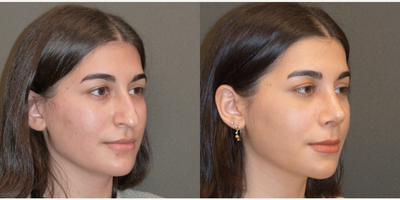 18-24 year old woman treated with Rhinoplasty - My lovely 23 years-old patient had rhinoplasty. She had extreme hump, hanging tip, deprojected tip and wide nasal base. I fixed and achieved result with open rhinoplasty without tampon inside. It was a 2 hour operation under general anesthesia, 6 days later  removed the tapes, She still has some swelling and will be better in 3-4 months.