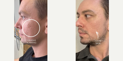 Man treated with Bellafill, Microneedling, CO2 Laser, Subcision - Man treated with Bellafill, Microneedling, CO2 Laser, Subcision