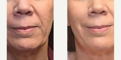Woman treated with Profound RF - Woman treated with Profound RF