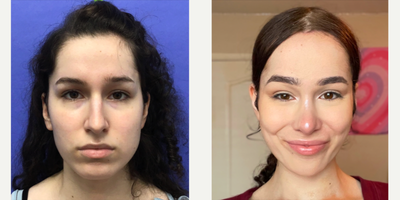 Patient treated with Cheek Augmentation - Cheek Implants (small) - 18 to 24 year-old female patient is 3 months post-op from Facial Feminization surgery. Her procedures included: Forehead Lift, Hairline Lowering, Orbital Bony Contouring, Septorhinoplasty (closed) with Cartilage Grafts, Cheek Implants (small), Chin Implant (central) with Reduction and Contour, Soft Tissue to Nasolabial Folds, Intranasal Lip Lift with Fascia to Lips and 300 Micrografts.