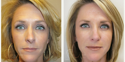 41year old woman treated with Liquid Facelift - 41year old woman treated with Liquid Facelift