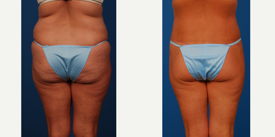 45-54 year old woman treated with Body Lift - concerned about excess skin in the tummy, back and buttox