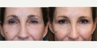 Upper Eyelid Filler - Volumizing the upper eyelids with filler using cannula.