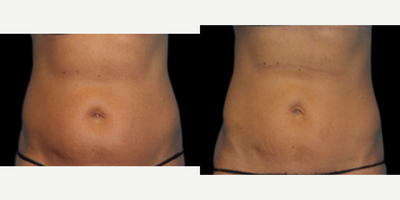 Patient after 4 Vanquish Treatments - Vanquish uses radiofrequency and heat to burn fat and tighten skin around the abdominal or thigh area. It is not an alternative for liposuction, but if someone is looking to lose anywhere from 1-4 inches around their waistline, Vanquish is a great option.&nbsp;We sell Vanquish in a package treatment of 4, any less and you won't see the results you're hoping for.&nbsp;