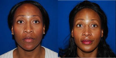 African American Rhinoplasty - Rhinoplasty