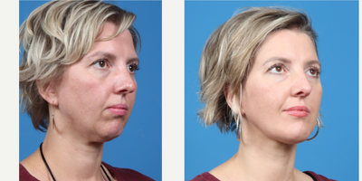 35-44 year old woman treated with Chin Implant, Neck Lift - 35-44 year old woman treated with Chin Implant, Neck Lift