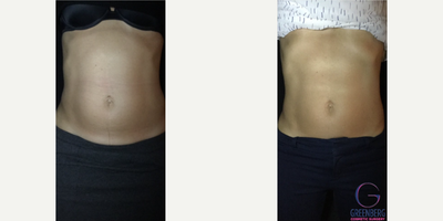 Woman treated with CoolSculpting - Woman treated with CoolSculpting, shown 12 weeks post op.