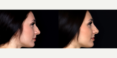 24 year old woman treated with Vollure, Nonsurgical Nose Job - 24 year old woman treated with 0.7 syringe of Vollure, Nonsurgical Nose Job. Photos depict before and immediately after treatment.