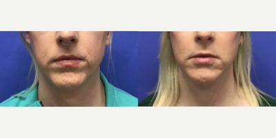 Patient treated with Chin Implant - Pre-Jowl Implant with Chin Reduction and Contour - 35 to 44 year-old female patient is 1 year post-op from Facial Feminization surgery. Her procedures included: Revision Forehead Lift and Orbital Bony Contouring, Septorhinoplasty with Cartilage Grafts and Weirs, Cheek Implants (small), Pre-Jowl Implant with Chin Reduction and Contour, Intranasal Lip Lift with Fat Augmentation, Thyroid Cartilage Shave and Voice Feminization, Revision Lower Eyelid Blepharoplasty (TC) with Fat Reposition and Fat Removal, Facelift/Necklift with Soft Tissue to Nasolabial Folds, TCA Peel - Lower Lids, and 1 cc Juvederm - Perioral.