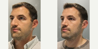 35-44 year old man treated with Rhinoplasty - Cosmetic rhinoplasty to deproject/narrow/rotate nasal tip, straighten nasal dorsum, and reduce the dorsal hump. Functional Septoplasty.
