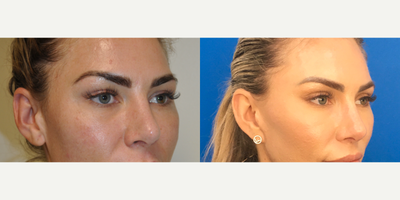Woman treated with Canthoplasty, Brow Lift, Rhinoplasty - Patient hadCanthoplasty,Mid face brow suspension,and rhinoplasty