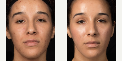 25-34 year old woman treated with Cosmelan - Cosmelan results after four months