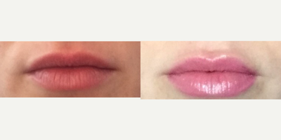 Lips with Volbella for This 31 Years Young Lady - This 31 year old woman had lip filler with Volbella. Results may last for up to one year. She is one week recovery.