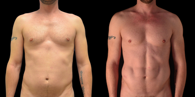 35-44 year old man treated with Body Jet - VASER/BodyJet Hi Definition Body Contouring with Fat Transfer