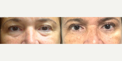 Woman treated with Eyelid Surgery - Curious about Blepharoplasty? Its the art of eyelid surgery that can do wonders for your appearance. Dr. Wolf specializes in this procedure, helping you say goodbye to droopy lids and under-eye bags.With years of experience and a commitment to delivering natural results, Dr. Wolf is your go-to expert for Blepharoplasty.