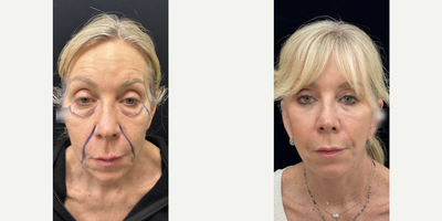 Woman treated with Deep Plane Facelift - Woman treated with Deep Plane Facelift