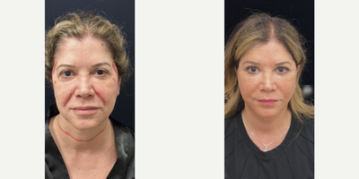 Woman treated with Facelift - Woman treated with Facelift