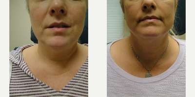 35-44 year old woman treated with Infini RF - Dr. Rapaport's actual patient before and after INFINI treatment for fat reduction and skin tightening