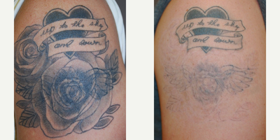 Cover-up tattoo treated with Picosure laser tattoo removal. - This patient had a cover-up done of an unwanted tattoo.  He was unhappy with the cover-up and wanted to remove the cover-up as well as the old tattoo except for the heart.  He is seen here after only three treatments with Picosure.  The cover-up is almost completely removed and the original tattoo will require a few additional treatments.  There is only mild temporary hypopigmentation, but no scarring.