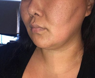 Opciones de Cirugia Estetica