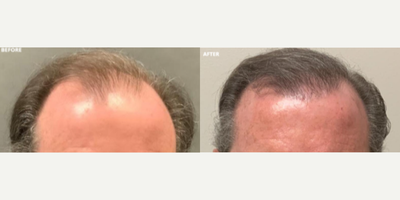 Man treated with FUE Hair Transplant - Man treated with FUE Hair Transplant for Hair Loss Treatment. Patient is shown before and 1 year post-op.