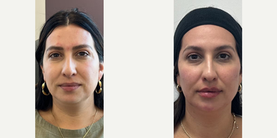 Woman treated with Dermal Fillers - Woman treated with Dermal Fillers