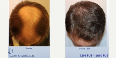 25-34 year old man treated with Hair Transplant - This 33-year-old man underwent a follicular unit extraction (FUE) session with Dr. Carlos K. Wesley in which a total of 3298 FUT and 2669 FUE grafts were placed Graft storage was optimized as hair follicles were incubated in autologous (his own) platelet rich plasma (PRP) throughout the duration of the procedure. This, combined with an ATP-containing storage solution has been shown to enhance survival of transplanted hairs.