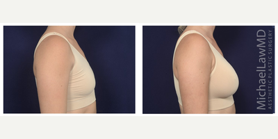 25-34 year old woman treated with Ideal Implant - Breast augmentation. Follow-up photo taken 1 month after the procedure.
