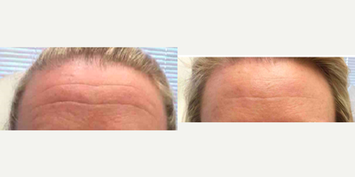 35-44 year old woman treated with Microneedling - 3 months following microneedling treatment used to erase forehead lines and wrinkles.