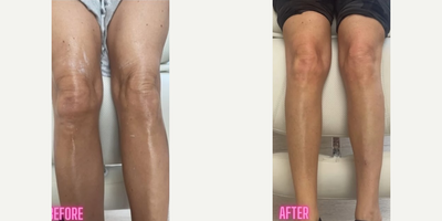 Woman treated with Sylfirm X - Say goodbye to crepey skin with our Sylfirm X radio frequency with microneedling treatment.