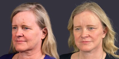 55-64 year old woman treated with ActiveFX, Brow Lift, Facelift, Laser Resurfacing, Lower Facelift, Neck Lift, SMAS Facelift - 56 year old who presented for facial rejuvenation. She is 5'5 and 158 pounds. She had a brow lift, lower face and neck lift, as well as central face CO2 laser skin resurfacing.