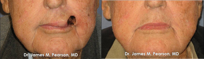 Lip Reconstruction - 
	Lip Reconstruction
