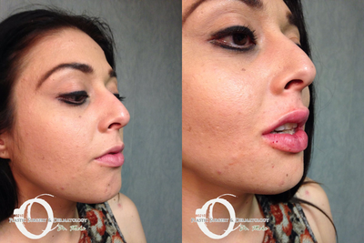 18-24 year old woman treated with Lip Augmentation - 18-24 year old woman treated with Lip Augmentation