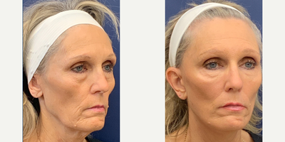 55-64 year old woman treated with Facelift, Brow Lift - 55-64 year old woman treated with Facelift, Brow Lift