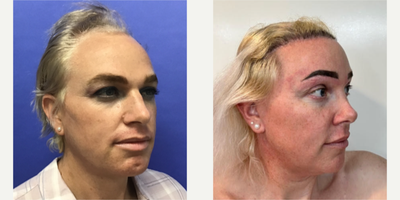 Patient treated with Facial Feminization Surgery, Transgender Facial Feminization Surgery, Septoplasty, Rhinoplasty, Cheek Augme - 25 to 44 year-old female patient is 2 years post-op from Facial Feminization surgery. Her procedures included: Placement of Tissue Expander for Mayer Flap, Forehead Lift and Orbital Bony Contouring, Septorhinoplasty (closed) with Cartilage Grafts and Weirs, Cheek Implants (small), Chin Reduction and Contour, Subnasal Lip Lift with Fat Augmentation to Lips, Medium Facelift, 1cc Voluma, Juvederm, Periorbital TCA Peel, and Mole Removal on Face. Patient is 1 year 5 months post-op from Removal of Tissue Expander and Rotate Flap. Patient is 3 months post-op from Dog Ear and 800 Micrografts to Hairline.